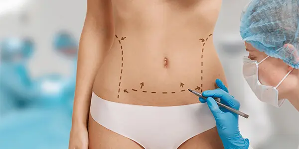 Abdominoplastia