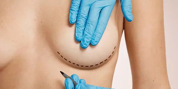 Mamoplastia