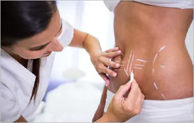 abdominoplastia cicatriz