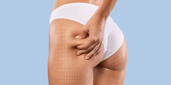 gluteoplastia gluteoplastia