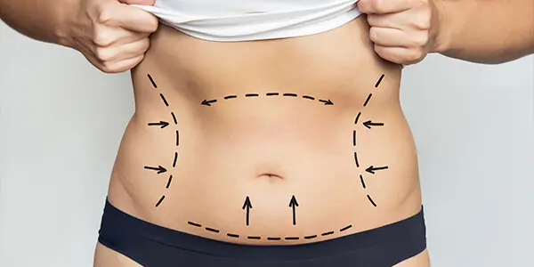 lipoaspiração lipoaspiração