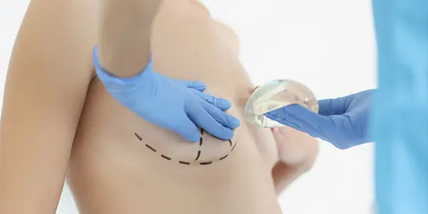 protese de silicone - m&eacute;dico marcando o contorno dos seios